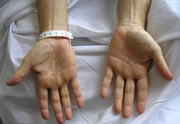 Syphilis op den Hänn als Ursaach vun der pathologescher Entladung vum Penis